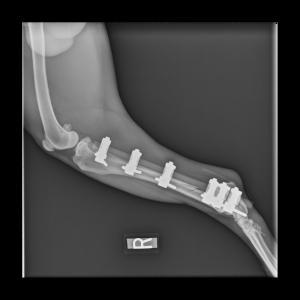 An external fixator used to stabilize a tibial fracture