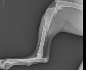 Preoperative tibia/fibula fracture
