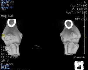 3-D image reconstruction of an elbow CT scan.