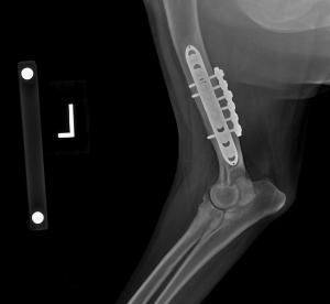 Patient with a Sliding Humeral Osteotomy (SHO).