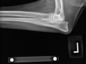 Patient with elbow dysplasia. Note the osteoarthritis present.