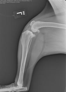 Left knee - note the joint swelling, arthritic changes, and forward movement of the tibia in relation to the femur. 