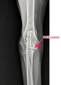Left Elbow: Osteochondritis Dissecans (OCD).