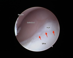 Noted the line in the cartilage outline a fragmented coronoid Process (FCP).