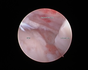 Note the underlying bone (pink). This is usually covered by cartilage, however the cartilage has become a flap. 