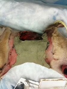 Applying BurnStat as the primary wound dressing