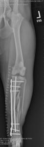 Tibia/fibula fracture repair