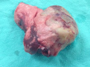 Excised lung tumor